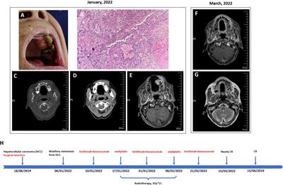 Encouraging efficacy of a comprehensive therapy consisting of sintilimab, bevacizumab biosimilar IBI305, hypo-fractionated intensity-modulated radiotherapy, and oxaliplatin for a maxillary metastasis from hepatocellular carcinoma: A case report and literature review